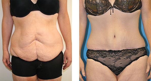 Am I A Good Candidate For A Tummy Tuck?