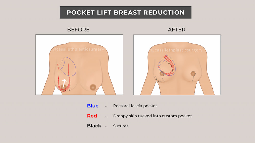 Pocket-Lift-Website-Infographic