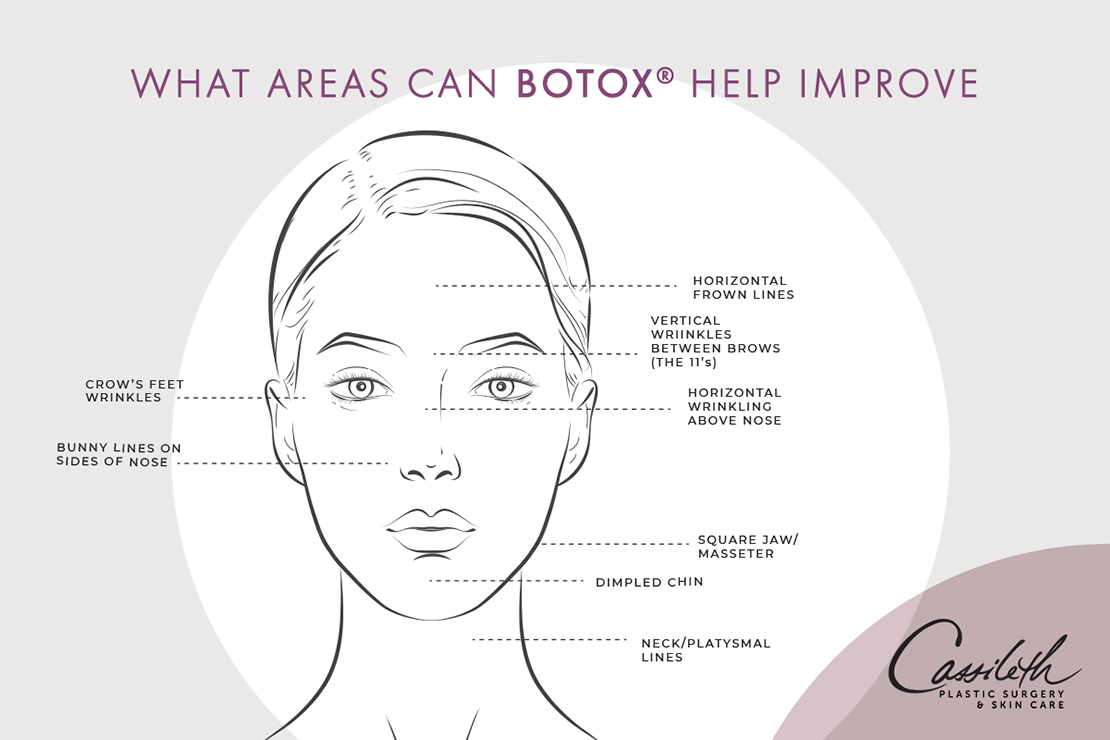 BOTOX® at Los Angeles' Cassileth Plastic Surgery is a versatile treatment that can help to improve the look of multiple facial areas.