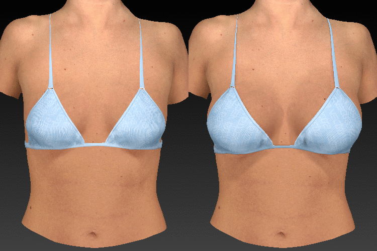 3D imaging for plastic surgery in Los Angeles