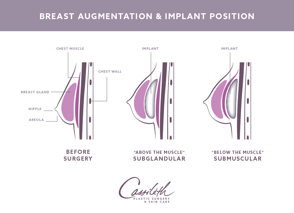 Discover the Benefits of Breast Implant Placement - Atlanta