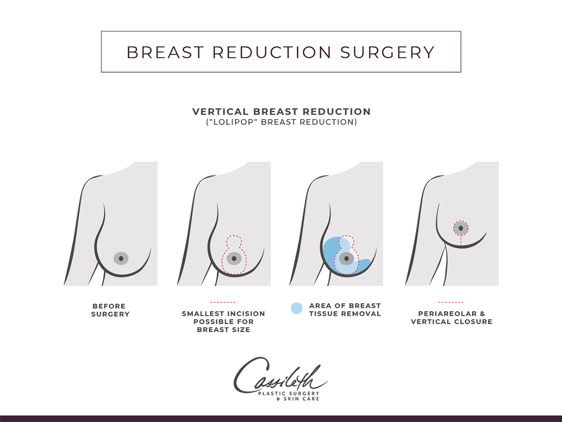 The Care After a Breast Reduction Procedure