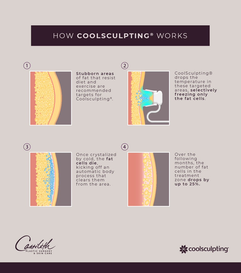 See how CoolSculpting® at Los Angeles' Cassileth Plastic Surgery involves identifying and treating unwanted pockets of fat, then watching volume in the area reduce.