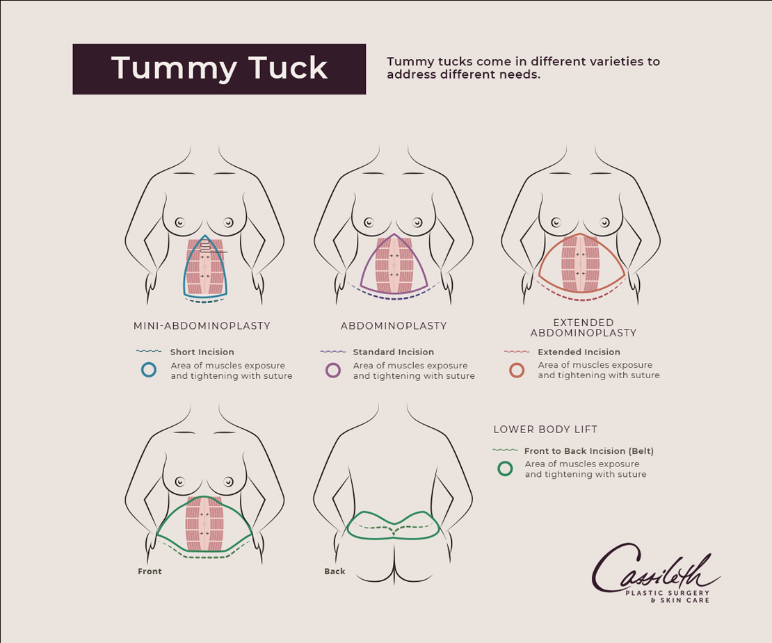 The specifics of a tummy tuck at Los Angeles' Cassileth Plastic Surgery—mini, standard, extended, or more—depend on how much excess skin the patient wants removed.