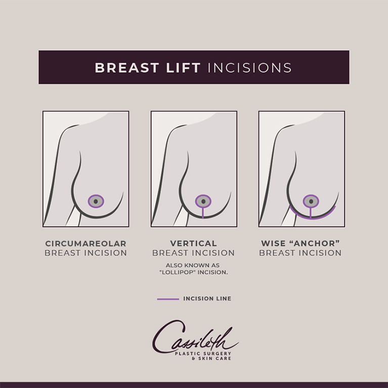 There are three different incision options for patients seeking a breast lift at Los Angeles' Cassileth Plastic Surgery.