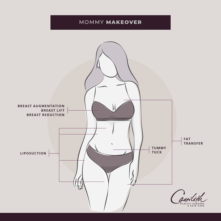 A Mommy Makeover at Los Angeles' Cassileth Plastic Surgery can include any of several types of breast surgery, fat reduction or transfer, and an abdomen-contouring tummy tuck. The goal is to restore pre-baby contours.