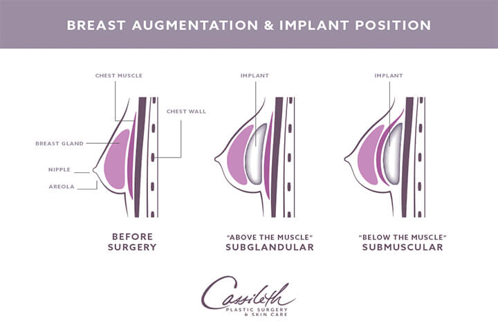 Breast Augmentation: When You Should – Or Shouldn’t – Have Breast Surgery