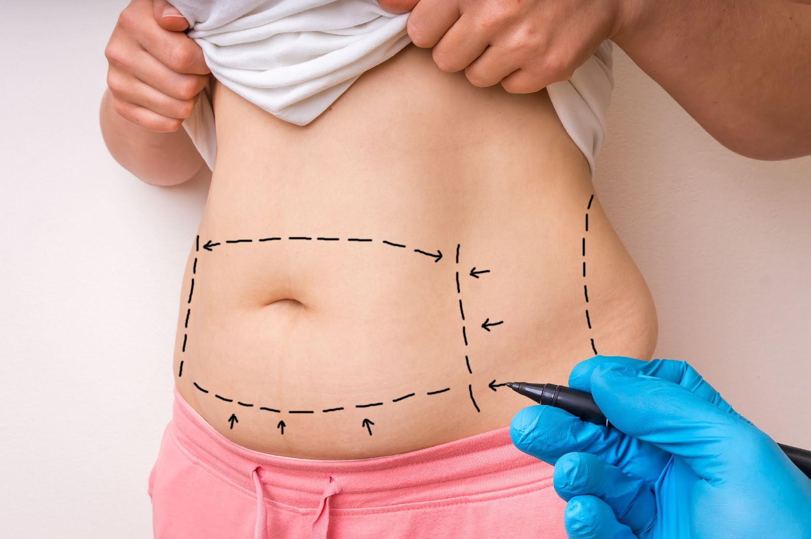 Plastic surgeon marking a patient’s abdomen with surgical lines before tummy tuck procedure.