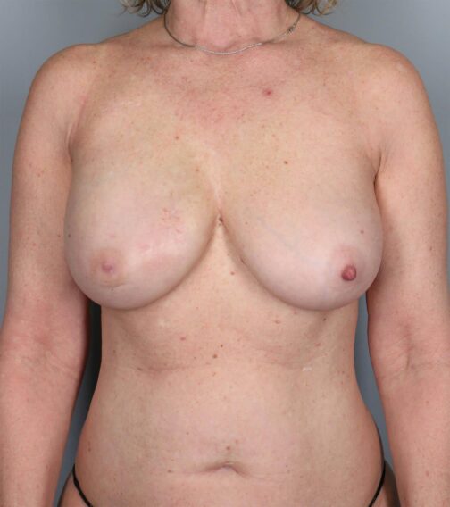 Case # 13 after photo