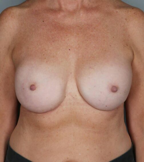 Case # 16 after photo