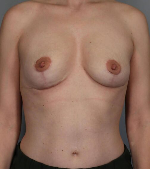 Case # 11 after photo