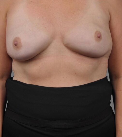 Case # 3 after photo