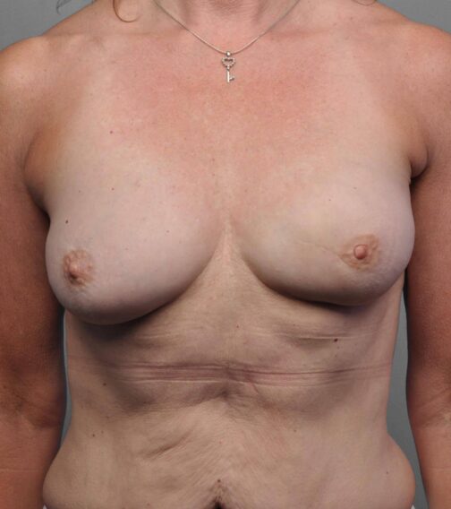 Case # 6 after photo