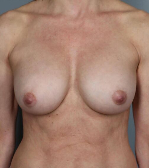 Case # 4 after photo