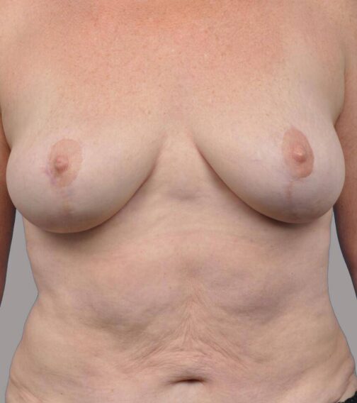 Case # 2 after photo