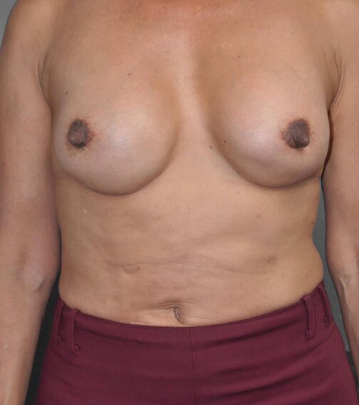 Case # 2 after photo