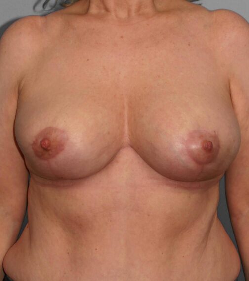 Case # 4 after photo