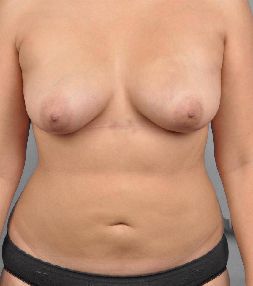 before and after gallery image