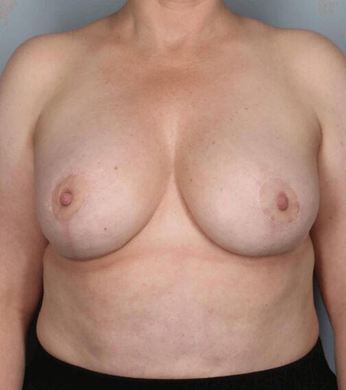 Case # 4 after photo