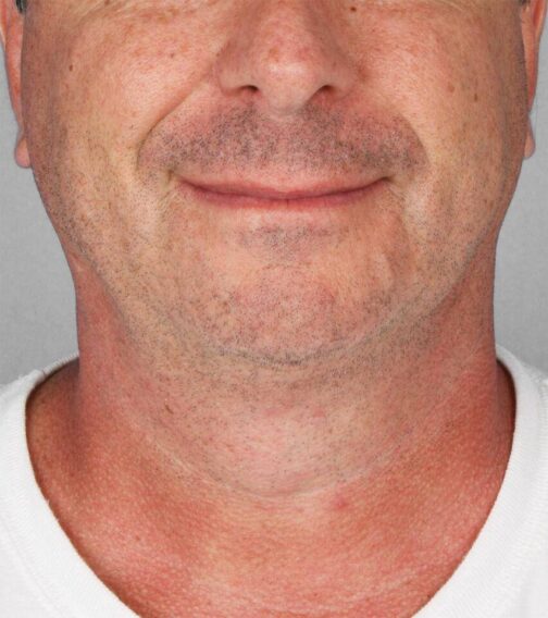 Case # 3 after photo