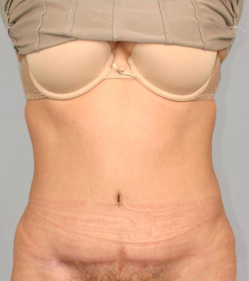 Case # 2 after photo