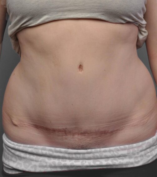 Case # 14 after photo