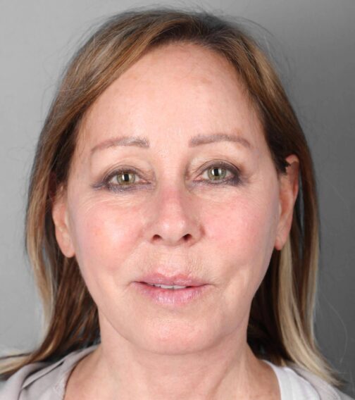 Case # 2 after photo