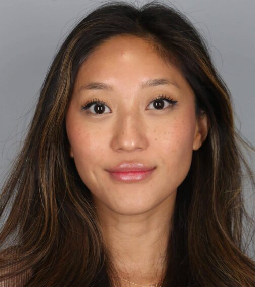 Case # 4 after photo