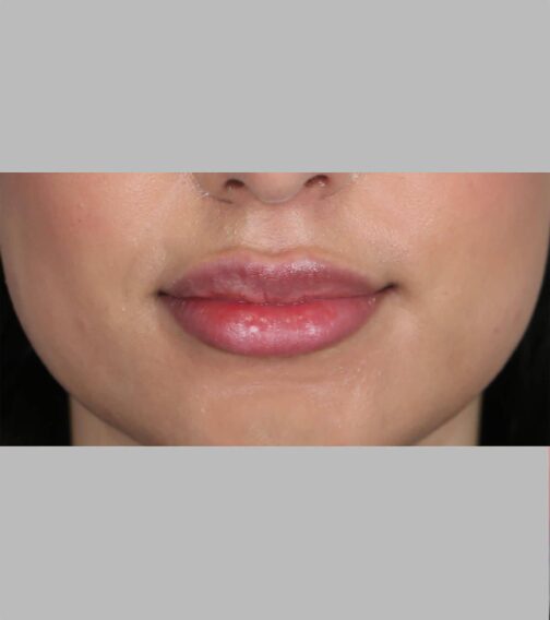 Case # 9 after photo