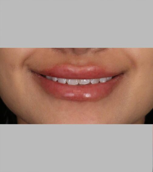 Case # 11 after photo