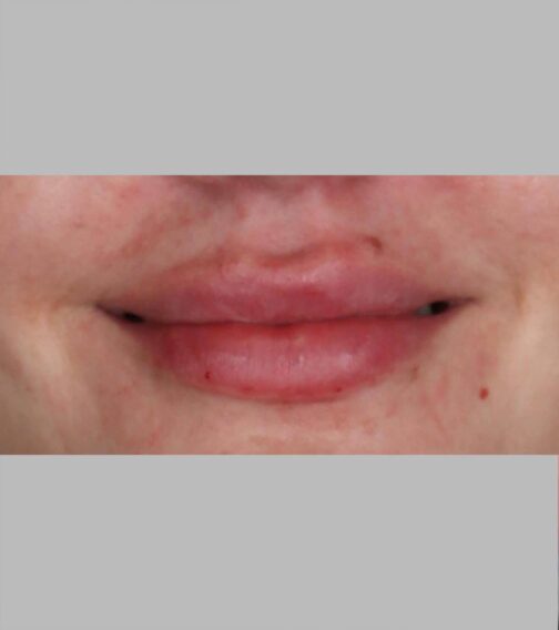 Case # 13 after photo