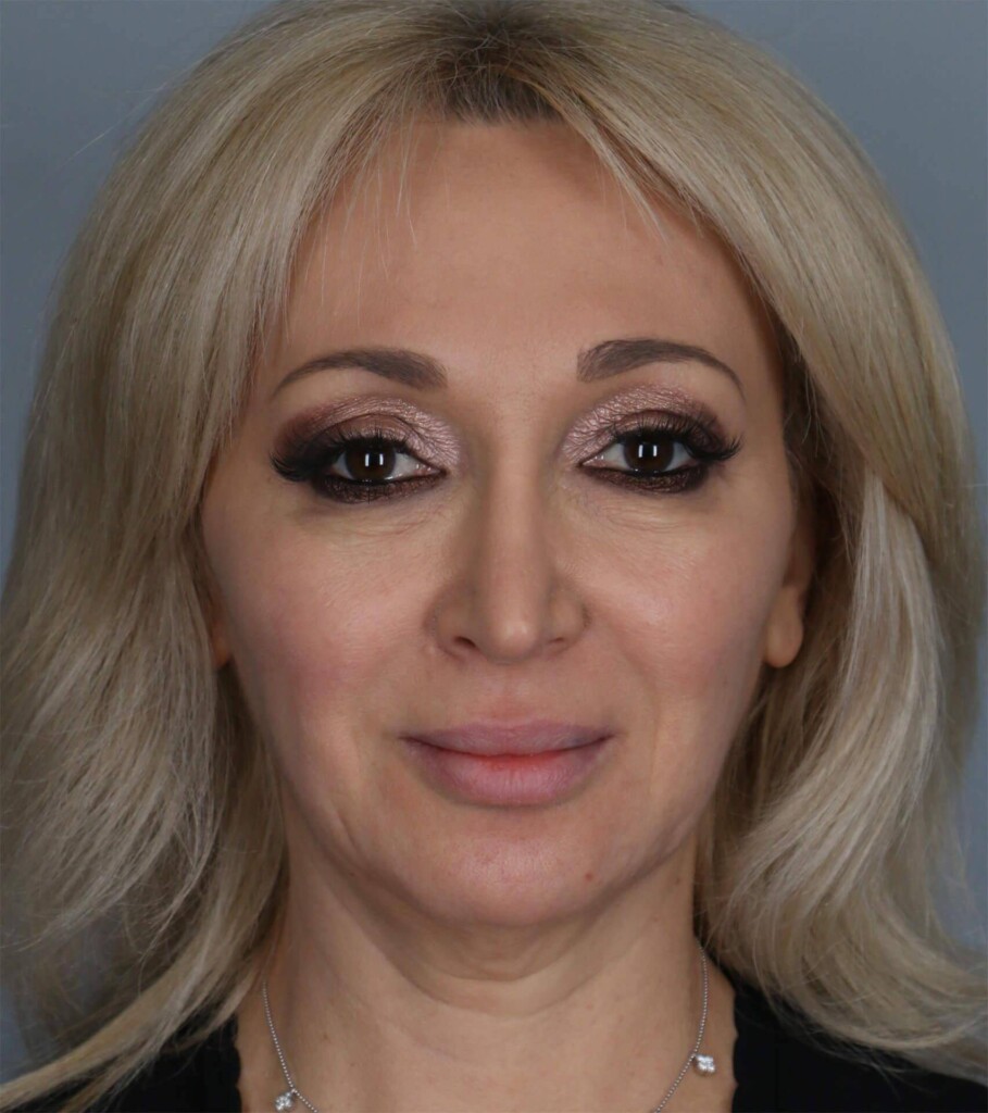 before and after gallery image