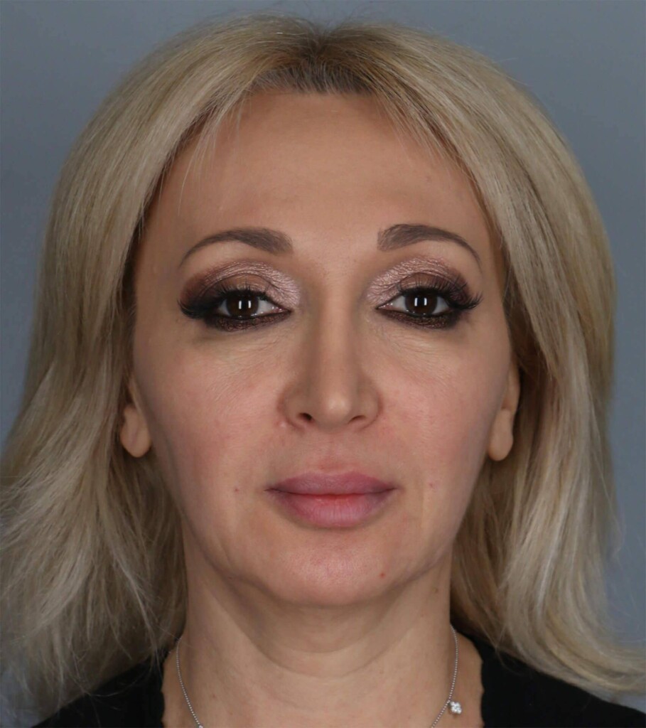 before and after gallery image