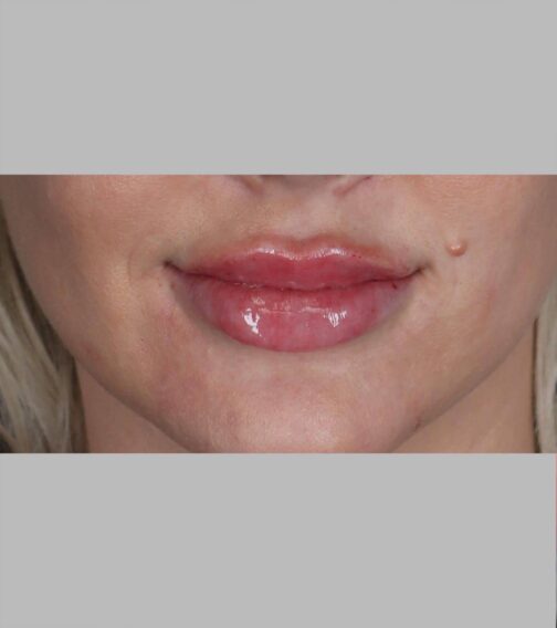 Case # 14 after photo