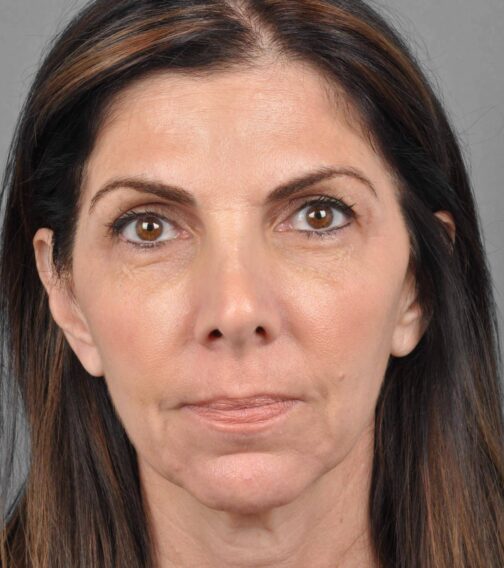 Case # 1 before photo