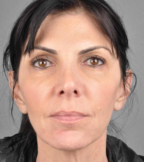 Case # 1 after photo