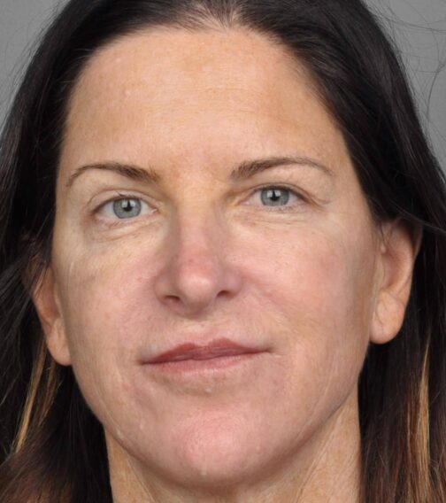 Case # 2 after photo