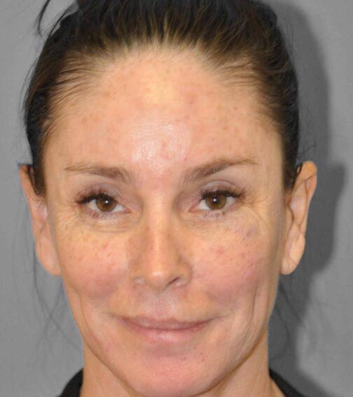 Case # 4 after photo