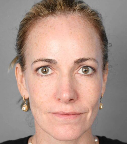 Case # 5 after photo