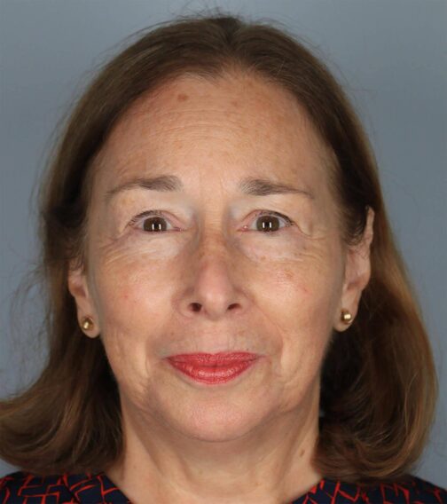 Case # 1 before photo