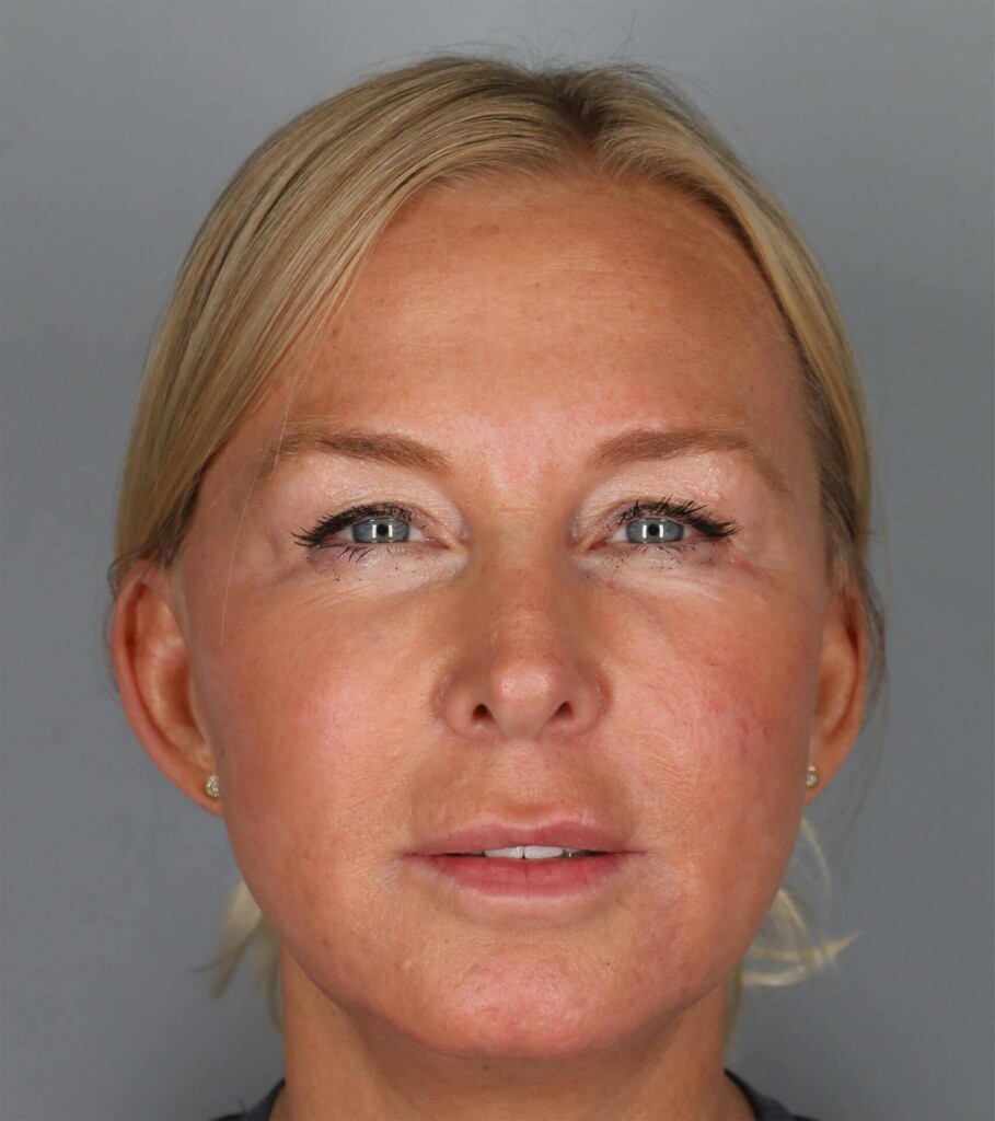 before and after gallery image