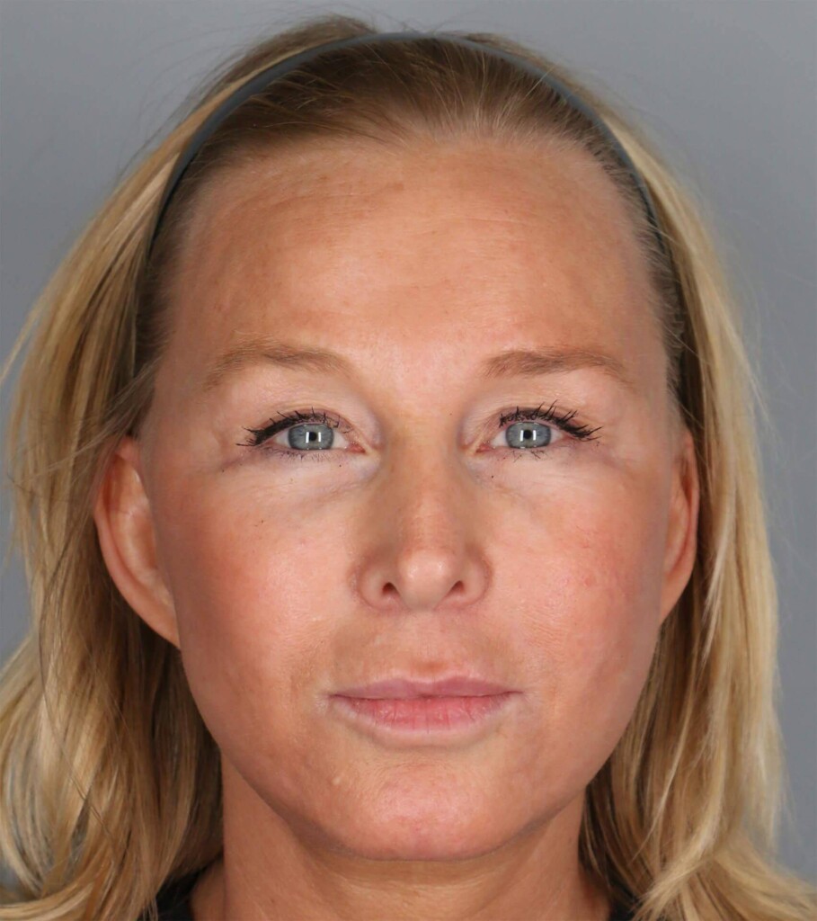 before and after gallery image