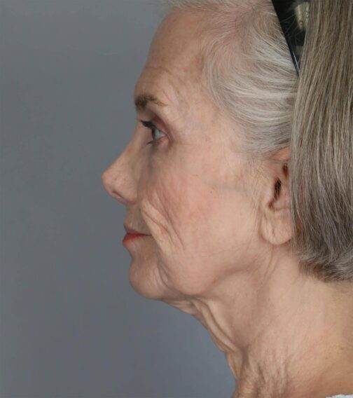 Case # 1 before photo