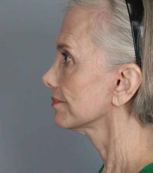 Case # 1 after photo