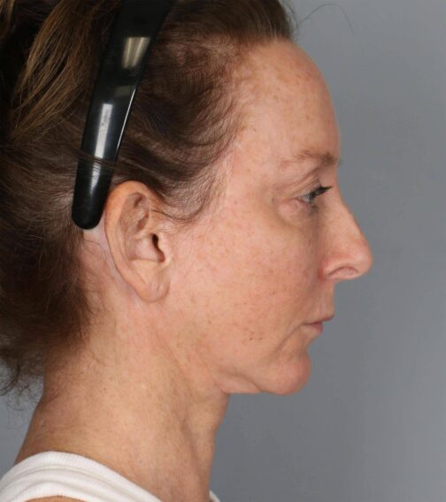 Case # 3 before photo