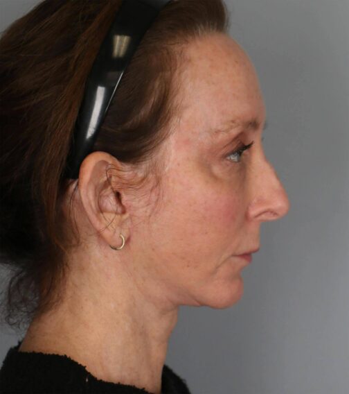 Case # 3 after photo